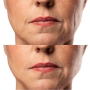 Микротоковый RF лифтинг-массажёр для лица MEDICA+ Skin Lifting 7.0 White - EMS, LED