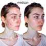 Вакуумный очиститель кожи и пор Medica+ SKINCLEANER 7.0